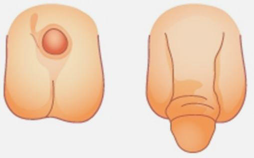 함몰음경