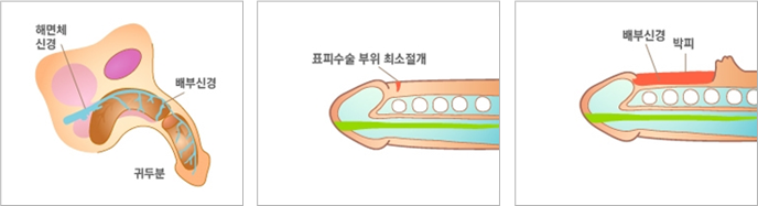 음경배부신경차단술