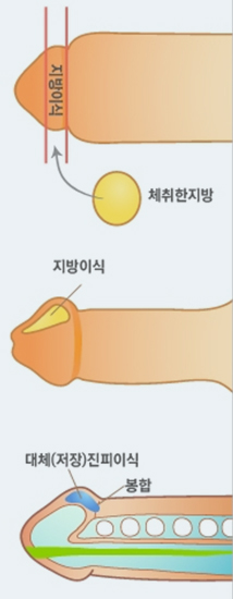 귀두확대